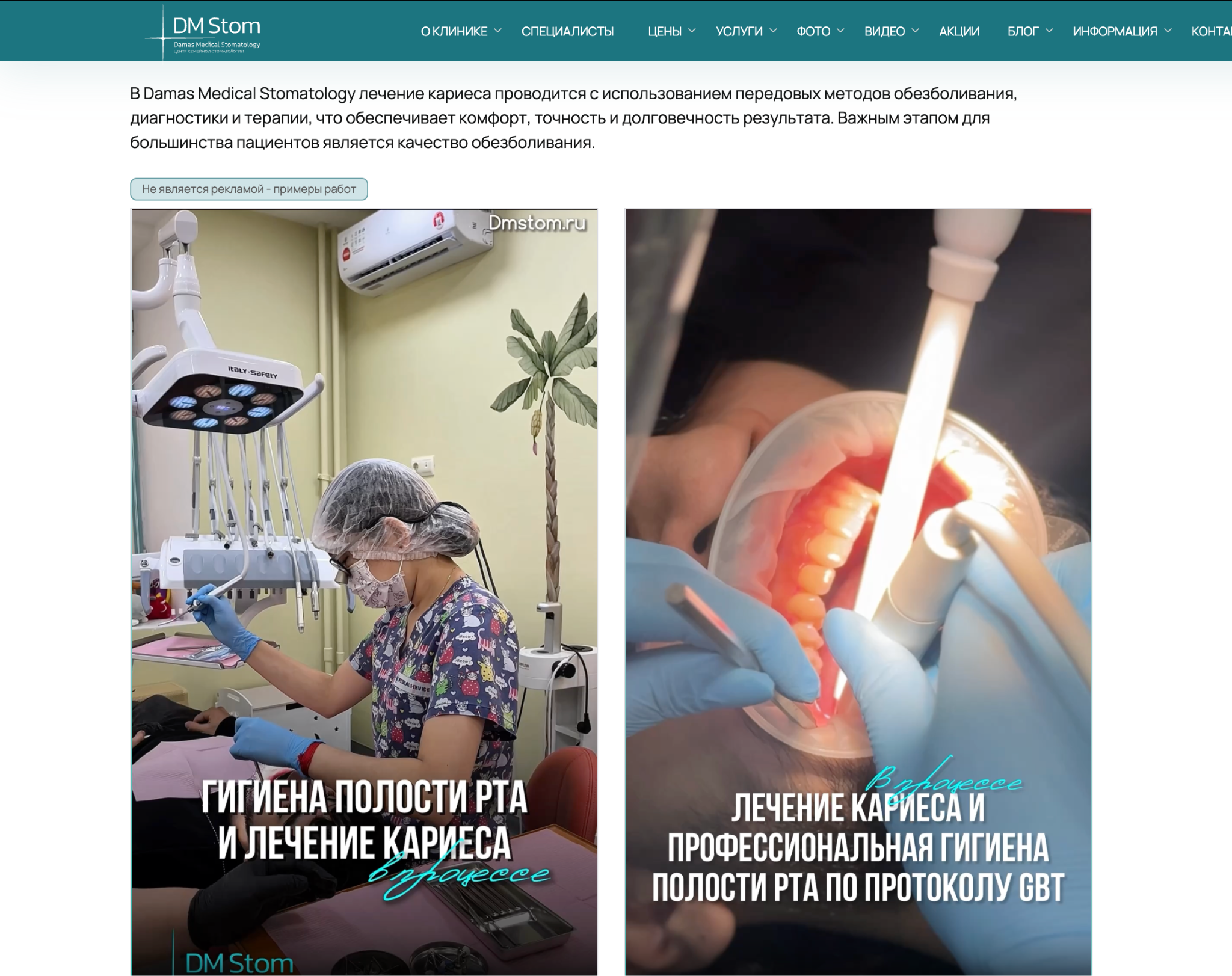 Превью статей блога стоматологии о гигиене и лечении кариеса